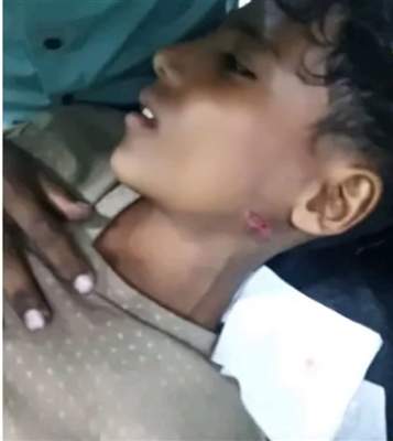 الضالع.. إصابة ثلاثة أطفال جراء انفجار مقذوف من مخلفات مليشيات الحوثي