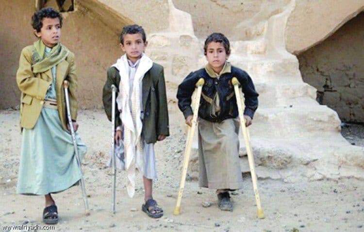 دعوة لضحايا ألغام الحوثي في الساحل الغربي للتواصل مع صندوق المعاقين